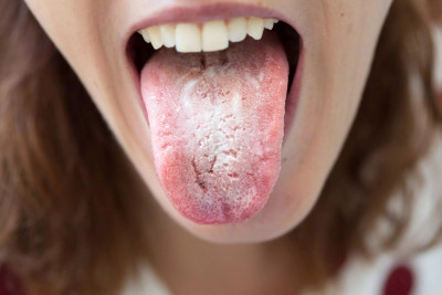 Infeksi Jamur di Mulut? Ini Beberapa Hal tentang Candidiasis Mulut